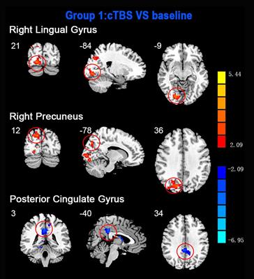 The After-Effects of Theta Burst Stimulation Over the Cortex of the Suprahyoid Muscle on Regional Homogeneity in Healthy Subjects